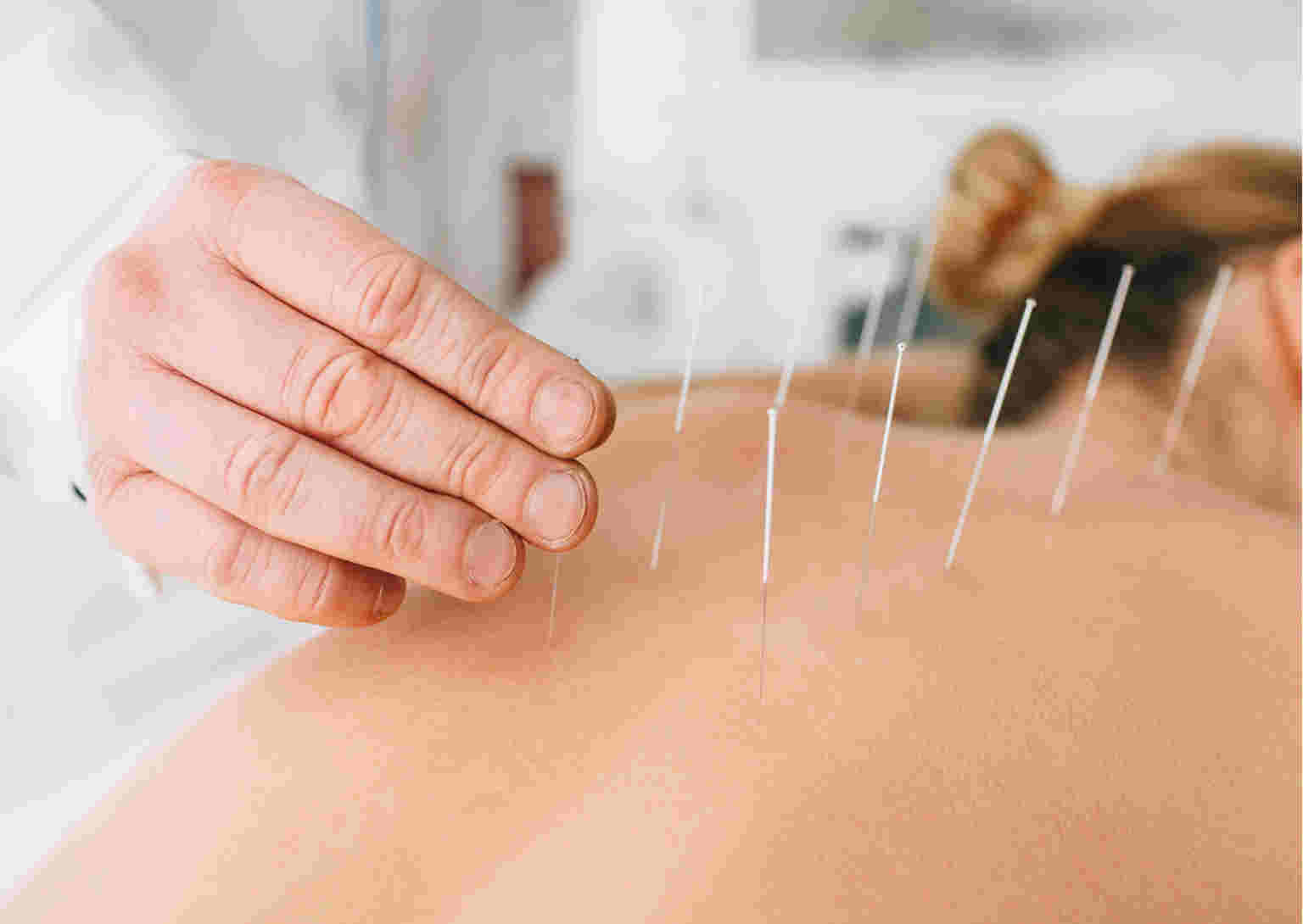 Accupuncture
